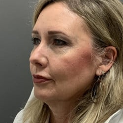 Before Image: Facelift and Upper Blepharoplasty by Dr. Henstrom - left-front-oblique