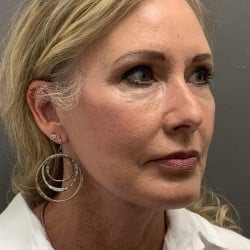 After Image: Facelift and Upper Blepharoplasty by Dr. Henstrom - right-front-oblique