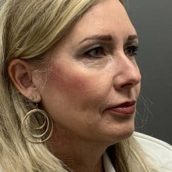 Before Image: Facelift and Upper Blepharoplasty by Dr. Henstrom - right-front-oblique