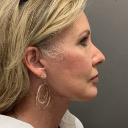 After Image: Facelift and Upper Blepharoplasty by Dr. Henstrom - right-side