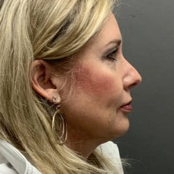 Before Image: Facelift and Upper Blepharoplasty by Dr. Henstrom - right-side
