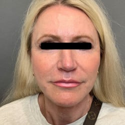 Estiramiento facial, inyecciones de grasa periorbitaria, dermoabrasión, blefa superior e inferior por el Dr. Thompson