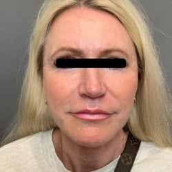 After Image: Facelift,  Periorbital Fat Injections, Dermabrasion, Upper & Lower Bleph by Dr. Thompson - front