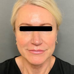 Estiramiento facial, inyecciones de grasa periorbitaria, dermoabrasión, blefa superior e inferior por el Dr. Thompson