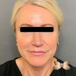 Facelift,  Periorbital Fat Injections, Dermabrasion, Upper & Lower Bleph by Dr. Thompson