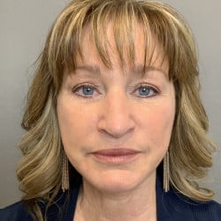 After Image: Facelift, Chin Implant, Browlift, and Lower Blepharoplasty by Dr. Thompson - front