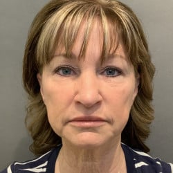 Before Image: Facelift, Chin Implant, Browlift, and Lower Blepharoplasty by Dr. Thompson - front