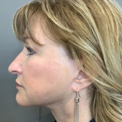 After Image: Facelift, Chin Implant, Browlift, and Lower Blepharoplasty by Dr. Thompson - left-side