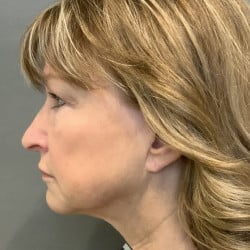 Before Image: Facelift, Chin Implant, Browlift, and Lower Blepharoplasty by Dr. Thompson - left-side