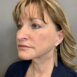After Image: Facelift, Chin Implant, Browlift, and Lower Blepharoplasty by Dr. Thompson - left-front-oblique