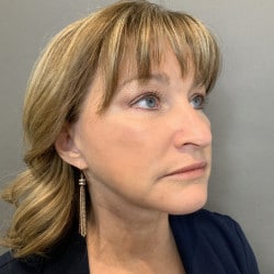 After Image: Facelift, Chin Implant, Browlift, and Lower Blepharoplasty by Dr. Thompson - right-front-oblique
