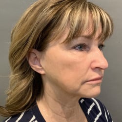Before Image: Facelift, Chin Implant, Browlift, and Lower Blepharoplasty by Dr. Thompson - right-front-oblique