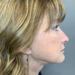 After Image: Facelift, Chin Implant, Browlift, and Lower Blepharoplasty by Dr. Thompson - right-side