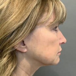 Before Image: Facelift, Chin Implant, Browlift, and Lower Blepharoplasty by Dr. Thompson - right-side