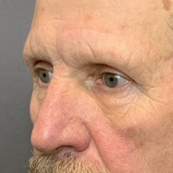After Image: Upper Blepharoplasty and Direct Browlift by Dr. Thompson - left-front-oblique