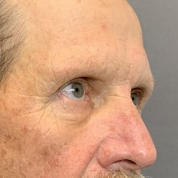 After Image: Upper Blepharoplasty and Direct Browlift by Dr. Thompson - right-front-oblique
