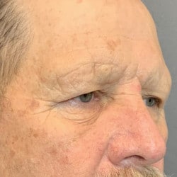 Before Image: Upper Blepharoplasty and Direct Browlift by Dr. Thompson - right-front-oblique