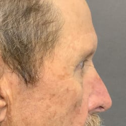 After Image: Upper Blepharoplasty and Direct Browlift by Dr. Thompson - right-side