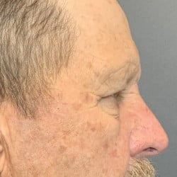 Before Image: Upper Blepharoplasty and Direct Browlift by Dr. Thompson - right-side