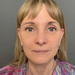 After Image: Facelift, Upper & Lower Blepharoplasty by Dr. Henstrom - front