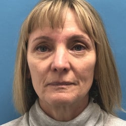 Before Image: Facelift, Upper & Lower Blepharoplasty by Dr. Henstrom - front