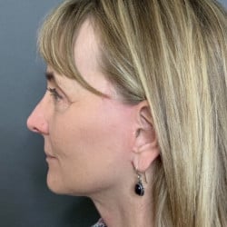 After Image: Facelift, Upper & Lower Blepharoplasty by Dr. Henstrom - left-side