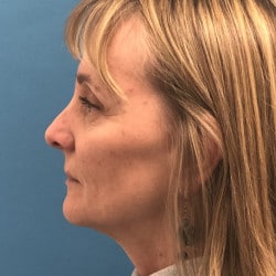 Before Image: Facelift, Upper & Lower Blepharoplasty by Dr. Henstrom - left-side