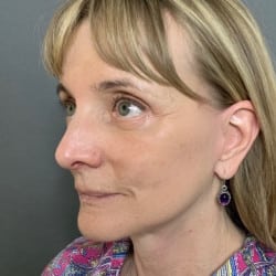 After Image: Facelift, Upper & Lower Blepharoplasty by Dr. Henstrom - left-front-oblique