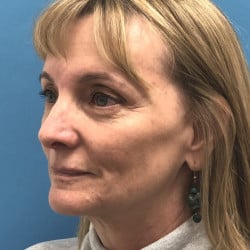 Before Image: Facelift, Upper & Lower Blepharoplasty by Dr. Henstrom - left-front-oblique