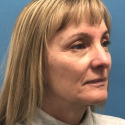 Before Image: Facelift, Upper & Lower Blepharoplasty by Dr. Henstrom - right-front-oblique