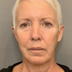 After Image: Facelift by Dr. Thompson