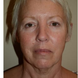Before Image: Facelift by Dr. Thompson