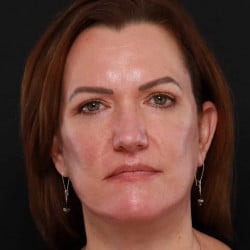 After Image: Facelift & Upper Blepharoplasty by Dr. Thompson -