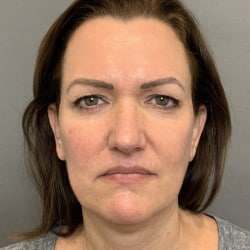 Before Image: Facelift & Upper Blepharoplasty by Dr. Thompson -