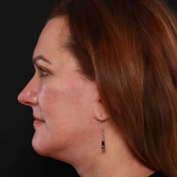 After Image: Facelift & Upper Blepharoplasty by Dr. Thompson - left-side