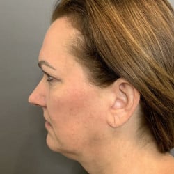 Before Image: Facelift & Upper Blepharoplasty by Dr. Thompson - left-side