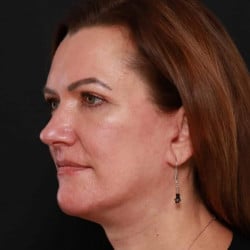 After Image: Facelift & Upper Blepharoplasty by Dr. Thompson -