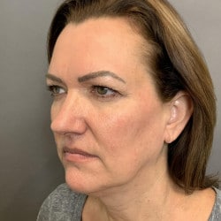 Before Image: Facelift & Upper Blepharoplasty by Dr. Thompson -