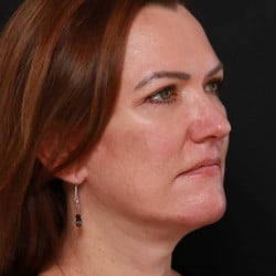 After Image: Facelift & Upper Blepharoplasty by Dr. Thompson - right-front-oblique