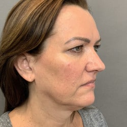 Before Image: Facelift & Upper Blepharoplasty by Dr. Thompson - right-front-oblique