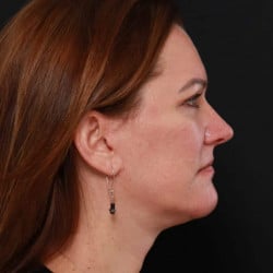 After Image: Facelift & Upper Blepharoplasty by Dr. Thompson - right-side