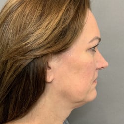Before Image: Facelift & Upper Blepharoplasty by Dr. Thompson - right-side
