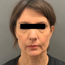 Before Image: Facelift, Fat Injections, Upper & Lower Blepharoplasty by Dr. Thompson - front