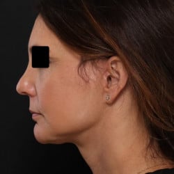 After Image: Facelift, Fat Injections, Upper & Lower Blepharoplasty by Dr. Thompson - left-side