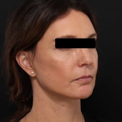 After Image: Facelift, Fat Injections, Upper & Lower Blepharoplasty by Dr. Thompson - right-front-oblique
