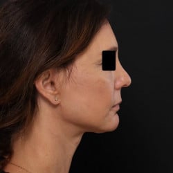 After Image: Facelift, Fat Injections, Upper & Lower Blepharoplasty by Dr. Thompson - right-side