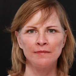 After Image: Facelift, Dermabrasion, Lower Blepharoplasty by Dr. Thompron - front