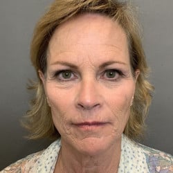 Before Image: Facelift, Dermabrasion, Lower Blepharoplasty by Dr. Thompron - front