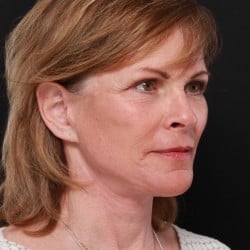 After Image: Facelift, Dermabrasion, Lower Blepharoplasty by Dr. Thompron - right-front-oblique