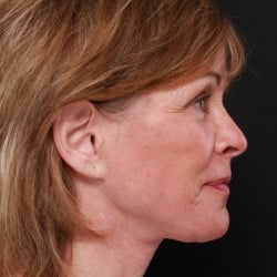 After Image: Facelift, Dermabrasion, Lower Blepharoplasty by Dr. Thompron - right-side